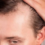Alopecia en pacientes transgénero: consideraciones dermatológicas y estrategias de tratamiento